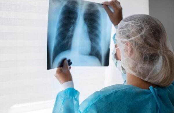 Pengobatan Tuberkulosis Dihentikan Akibat Alami Efek Samping, Aman Dilakukan?