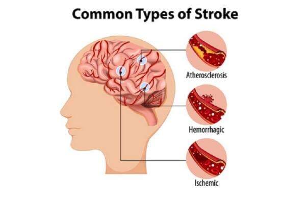 Hamdan ATT Meninggal karena Stroke, Simak 5 Gejala Penyakit Ini Hamdan ATT Meninggal karena Stroke, Simak 5 Gejala Penyakit Ini