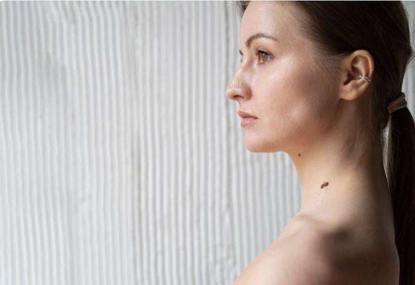 Tahi Lalat Bisa Jadi Tanda Kanker Kulit, Kok Bisa? Tahi Lalat Bisa Jadi Tanda Kanker Kulit, Kok Bisa?