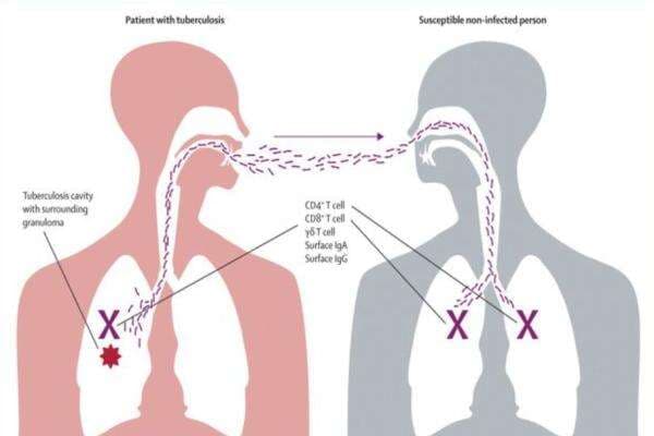 Vaksin TBC Diuji Coba, Ini Gejala Tuberkulosis yang Patut Diwaspadai Vaksin TBC Diuji Coba, Ini Gejala Tuberkulosis yang Patut Diwaspadai