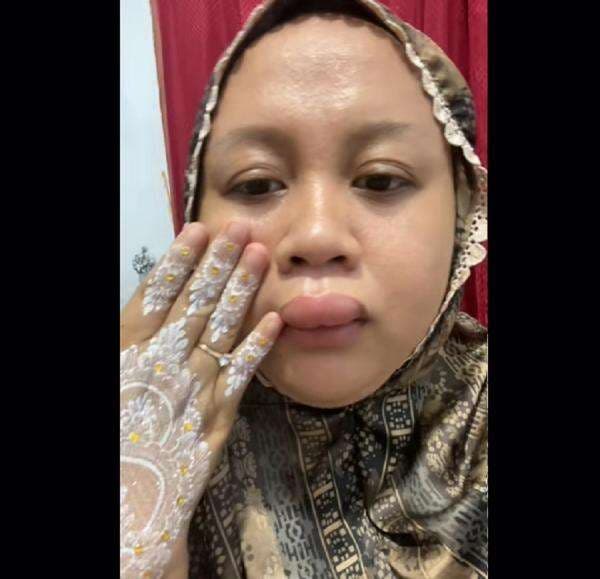 Cerita Pengantin Bibir Jeding yang Viral, Ternyata Ini Penyebabnya Cerita Pengantin Bibir Jeding yang Viral, Ternyata Ini Penyebabnya