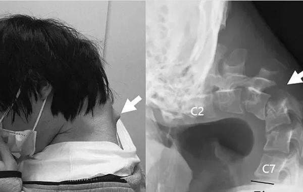 Waduh! Tulang Leher Pemuda Ini Bengkok Akibat Terlalu Lama Bermain Ponsel Waduh! Tulang Leher Pemuda Ini Bengkok Akibat Terlalu Lama Bermain Ponsel