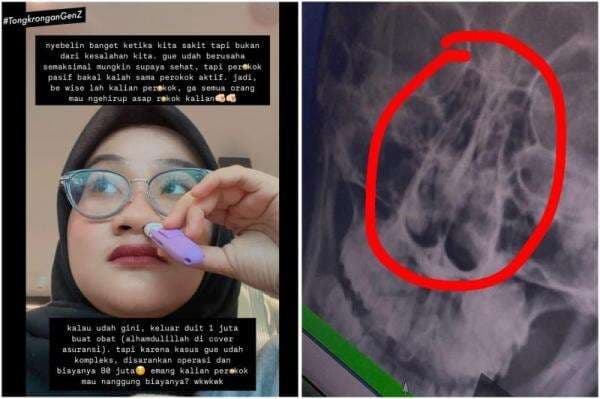 Heboh Gara-Gara Asap Rokok Perempuan Muda Alami Hipertrofi Konka, Disarankan Operasi Biaya Rp80 Juta! Heboh Gara-Gara Asap Rokok Perempuan Muda Alami Hipertrofi Konka, Disarankan Operasi Biaya Rp80 Juta!