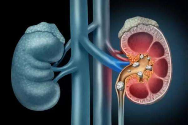 Waspada! 5 Kebiasaan Sehari-hari Ini Bisa Picu Gagal Ginjal Tanpa Disadari Waspada! 5 Kebiasaan Sehari-hari Ini Bisa Picu Gagal Ginjal Tanpa Disadari